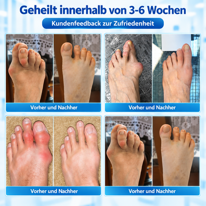 🏅 Natravor® Botanisches Komfort-Pflaster bei Hallux valgus 👠（ Flexible Fußpflege + pflanzlich inspirierte Komfortformel）a