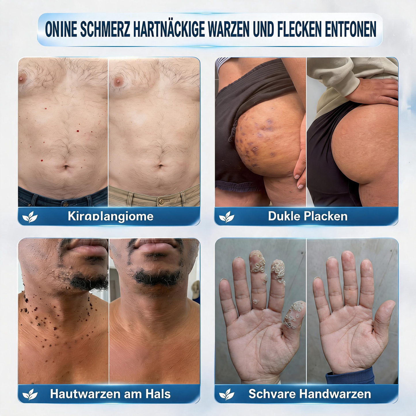 Natravor® 𝟕-𝐓𝐚𝐠𝐞 𝐇𝐚𝐮𝐭𝐚𝐧𝐡ä𝐧𝐠𝐬𝐞𝐥- & 𝐅𝐥𝐞𝐜𝐤𝐞𝐧-𝐄𝐧𝐭𝐟𝐞𝐫𝐧𝐮𝐧𝐠𝐬𝐜𝐫𝐞𝐦𝐞 (𝐒𝐜𝐡𝐦𝐞𝐫𝐳𝐟𝐫𝐞𝐢𝐞 𝐅𝐨𝐫𝐦𝐞𝐥 – 𝐨𝐡𝐧𝐞 𝐍𝐚𝐫𝐛𝐞𝐧)