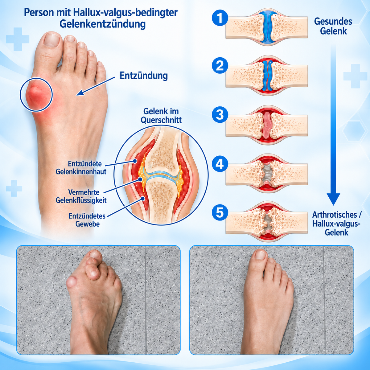 🏅 Natravor® Botanisches Komfort-Pflaster bei Hallux valgus 👠（ Flexible Fußpflege + pflanzlich inspirierte Komfortformel）a