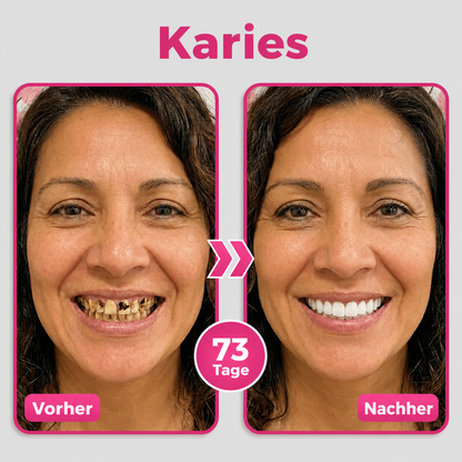 🪥Natravor® Thismile NH-10 Zahnpasta-Serum für Zahnschmelz und Zahnfleisch – Advanced Therapy