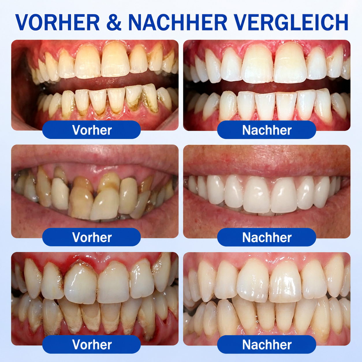 🇩🇪🏅🦷🛡️𝐍𝐚𝐭𝐫𝐚𝐯𝐨𝐫® Zahnfleischpflege- & Parodontalgel