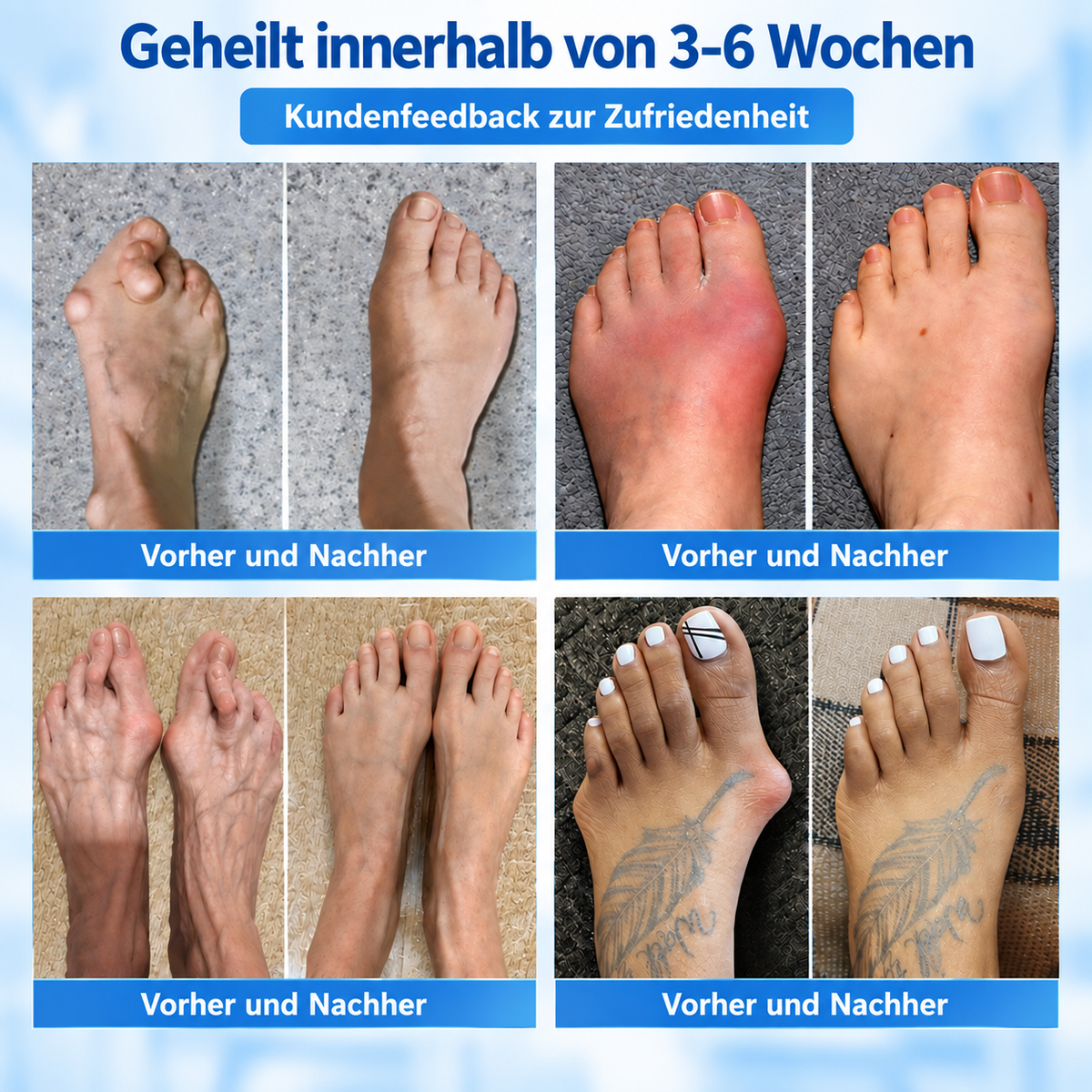 🏅 Natravor® Botanisches Komfort-Pflaster bei Hallux valgus 👠（ Flexible Fußpflege + pflanzlich inspirierte Komfortformel）a