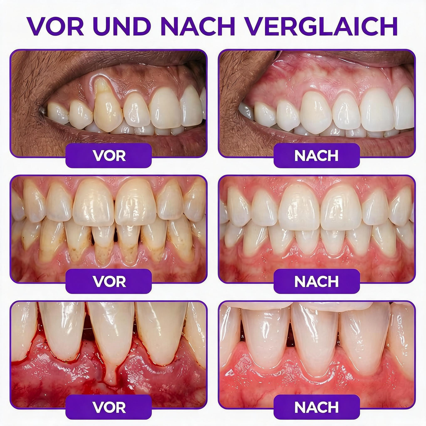 🇩🇪 𝐍𝐚𝐭𝐫𝐚𝐯𝐨𝐫® VioCore Zahnpasta zur Behandlung von Zahnfleischentzündungen und Parodontitis mit Bienengift